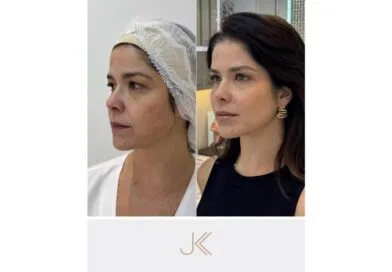 Samara Felippo aposta em protocolo de rejuvenescimento facial aliado ao tratamento de melasma na JK Estética Avançada