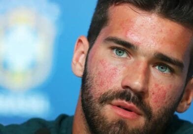 O que é a Rosácea? Dermatologista explica doença revelada pelo goleiro Alisson Becker
