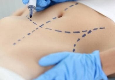 A cirurgia plástica entrou na era dos detalhes: por que o umbigo se tornou uma das maiores preocupações de quem faz abdominoplastia